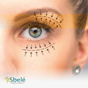 Blefaroplastia - Cirugía de Párpados