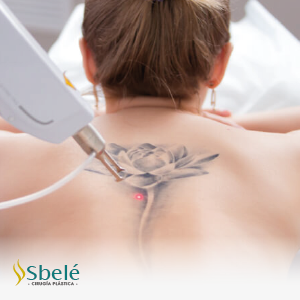 Retiro de Tatuajes: Recupera tu Piel con Tecnología Avanzada