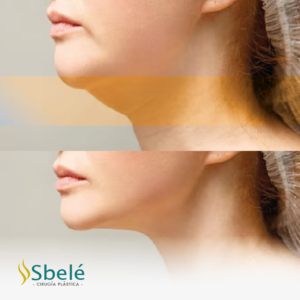 Lipo Papada: Redefine tu Perfil con Confianza